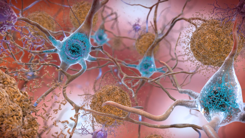 Alzheimer's neurons