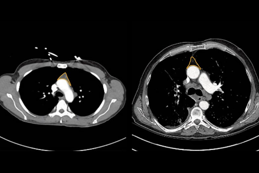 Example CT scans show participants with high (left) and low (right) thymus health scores.