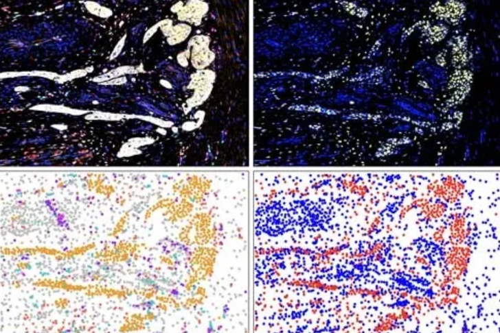 tumor microenvironment of pancreatic cancer